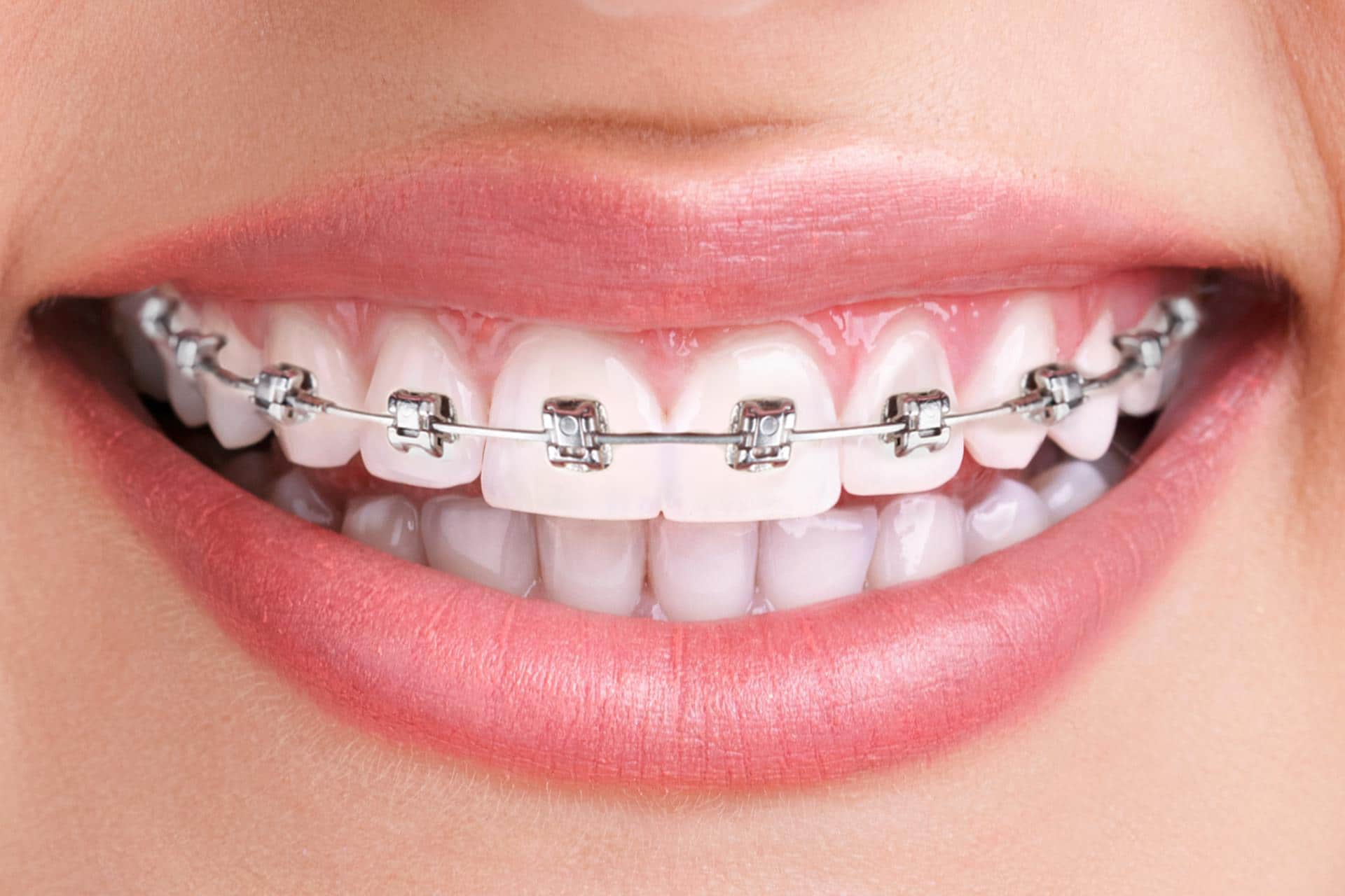 Установка брекетов в Уфе: Во сколько обойдется красивая улыбка в стоматологиях города