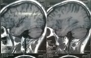 В Башкирии нейрохирургии провели сложнейшую операцию на мозге пациента с раком 