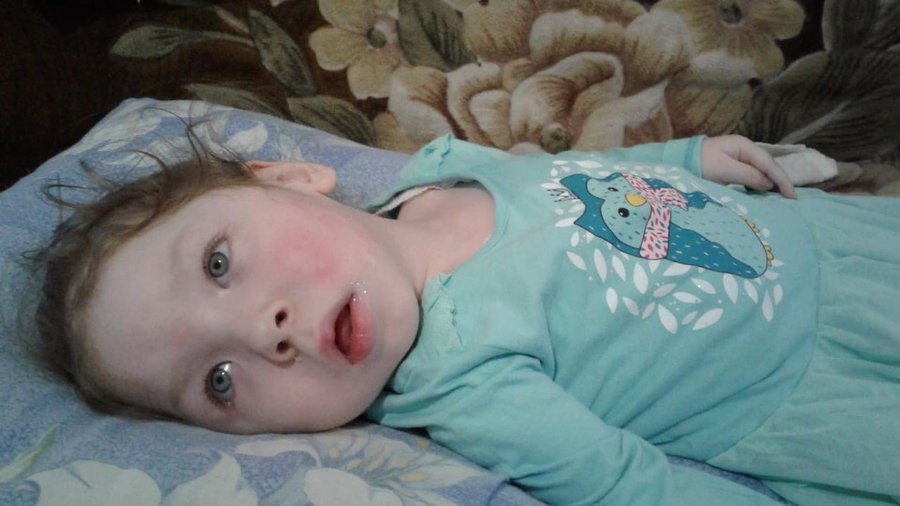 В Башкирии двухлетняя девочка с синдромом Отахара нуждается в помощи