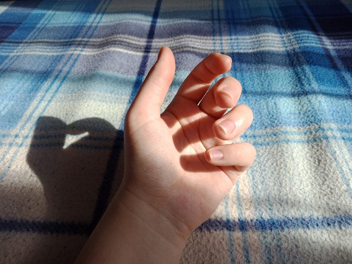 Четыре признака на руках могут предупреждать о синдроме запястного канала
