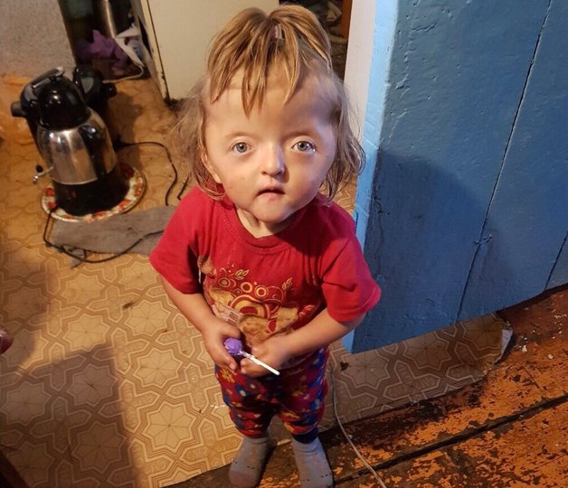 Двухлетняя девочка из глубинки Башкирии, которую не берут в садик из-за внешности, получила первую помощь