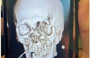 В уфимской больнице пациентке реконструировали лицо