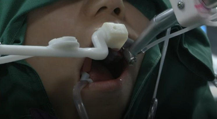 Китайский робот-дантист поставил импланты, изготовленные на 3D-принтере