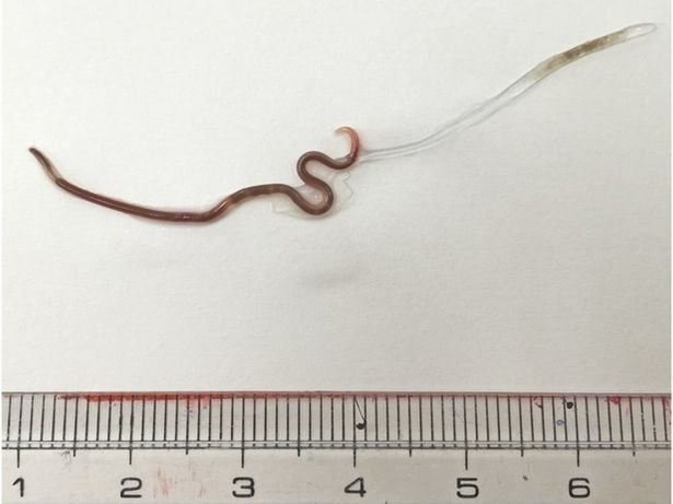 В миндалинах японки обнаружили живого червя после употребления сашими